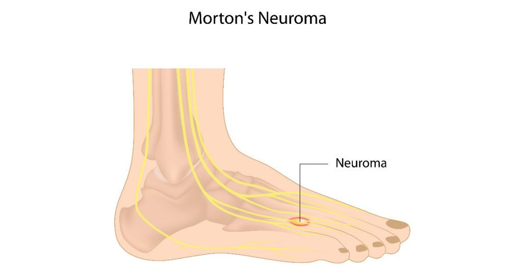 nevrinoma-morton